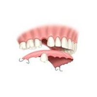 Intelident Treatments - Dental implants - Alternatives to Implants - INTELIDENT ...